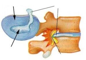 Destruction de l'anneau fibreux avec ostéochondrose cervicale